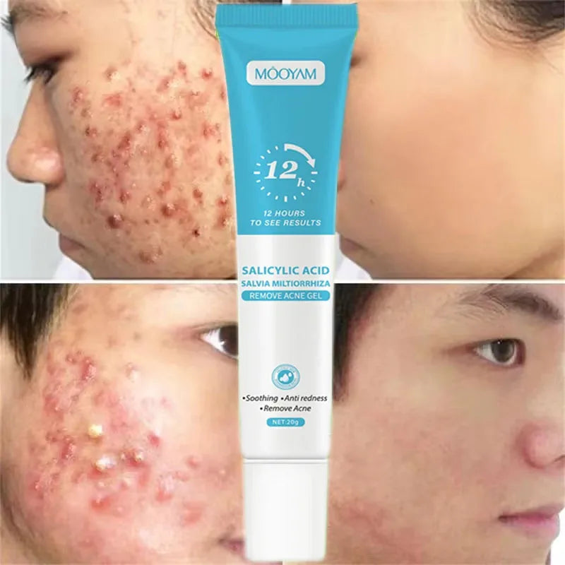 Crema para eliminar el acné Mooyan