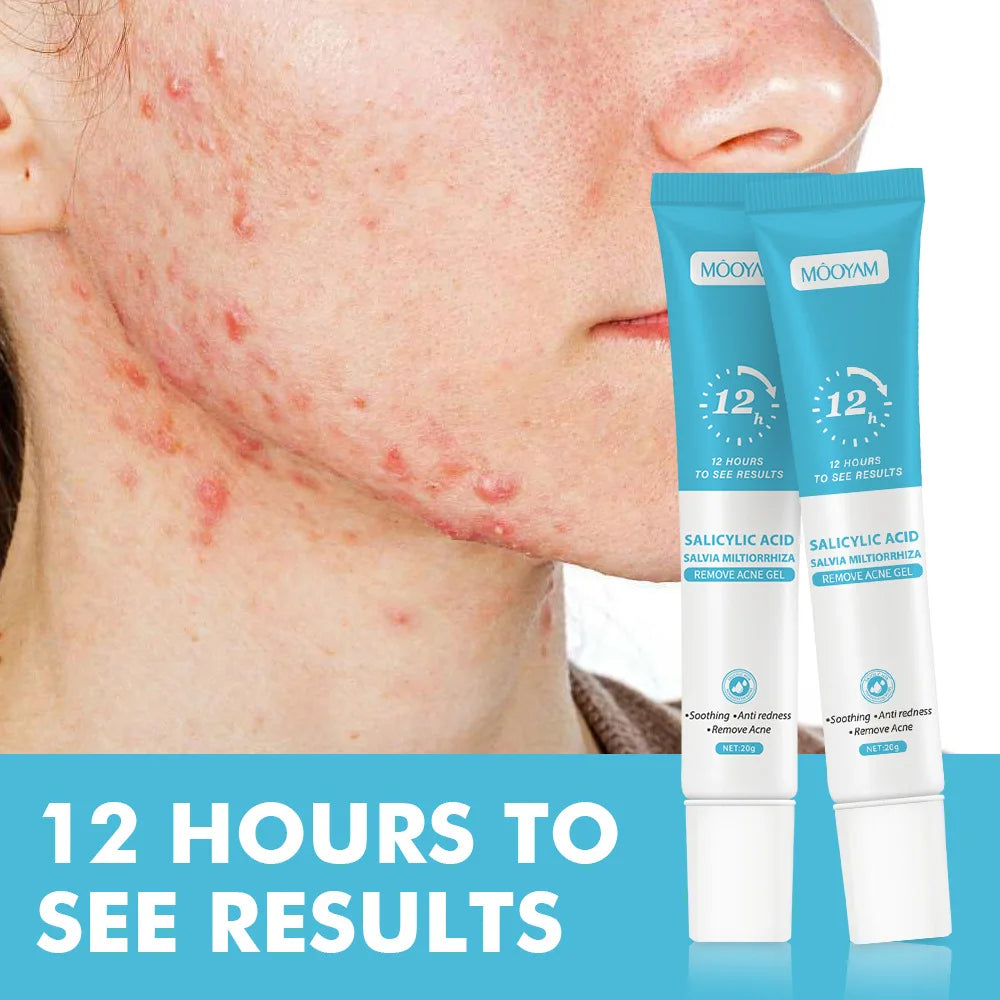 Crema para eliminar el acné Mooyan