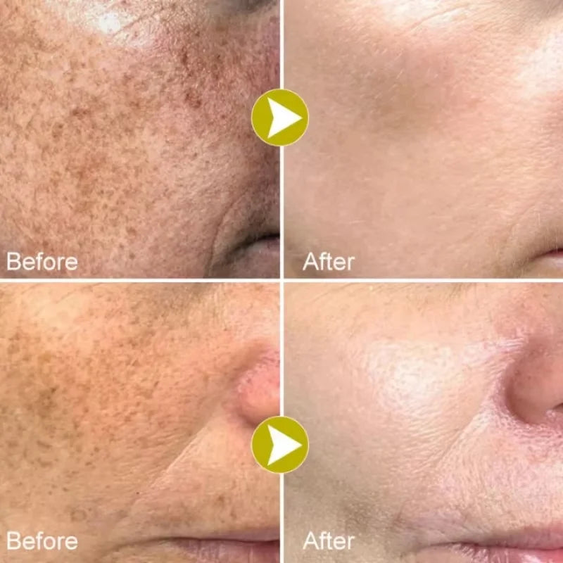 Sérum Facial Blanqueador de Niacinamida y Vitamina C