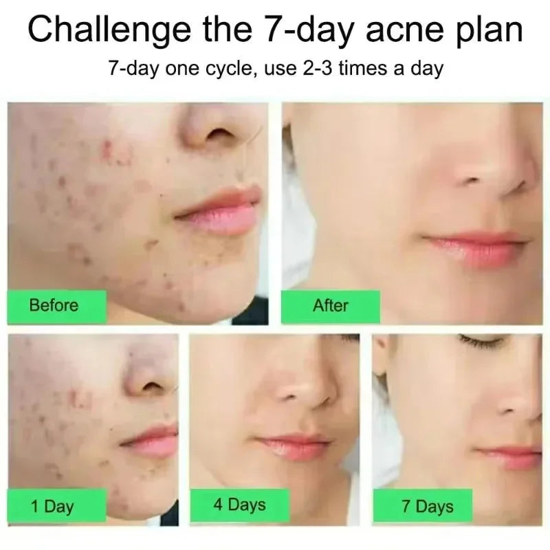 Crema para eliminar el acné Mooyan