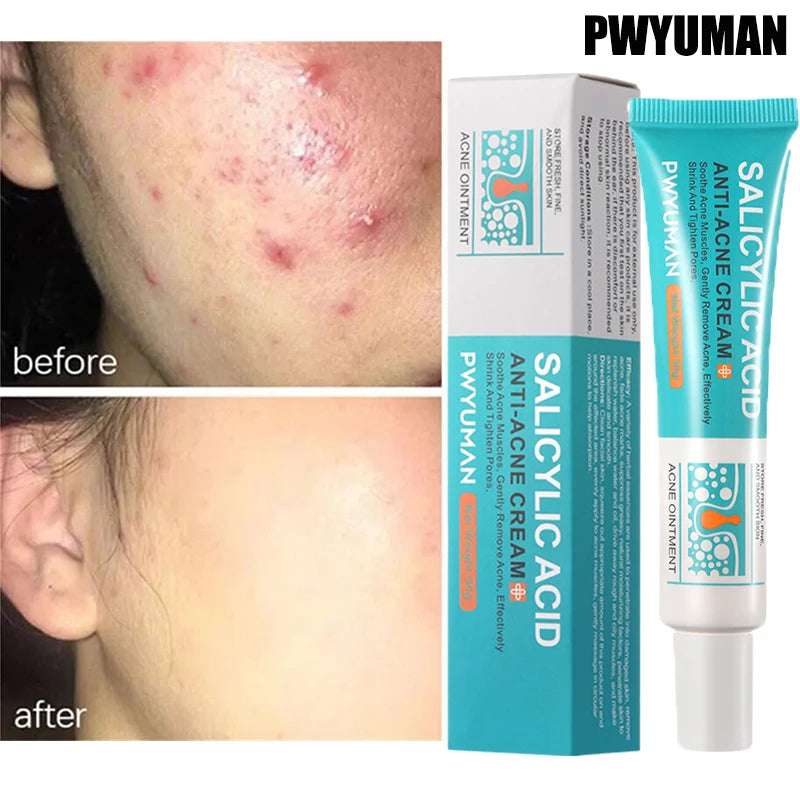 Crema Anti-Acné con Ácido Salicílico.
