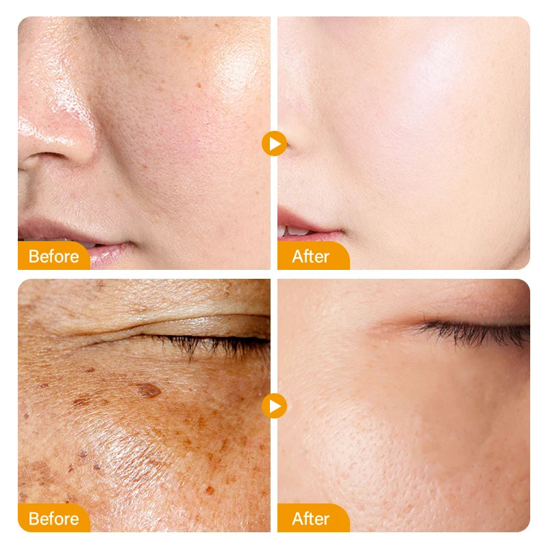 Sérum Facial Blanqueador de Niacinamida y Vitamina C