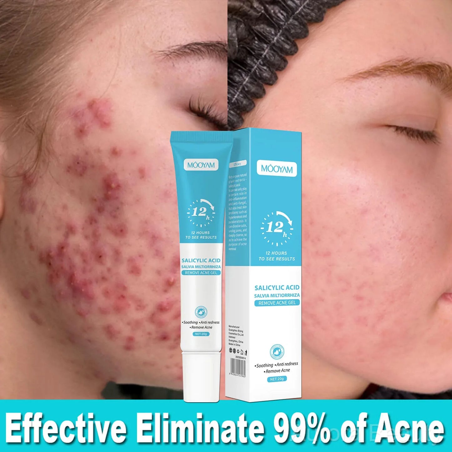 Crema para eliminar el acné Mooyan