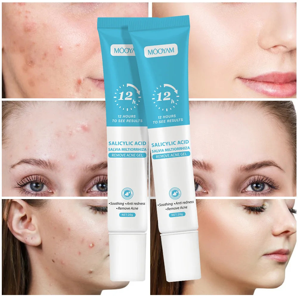 Crema para eliminar el acné Mooyan